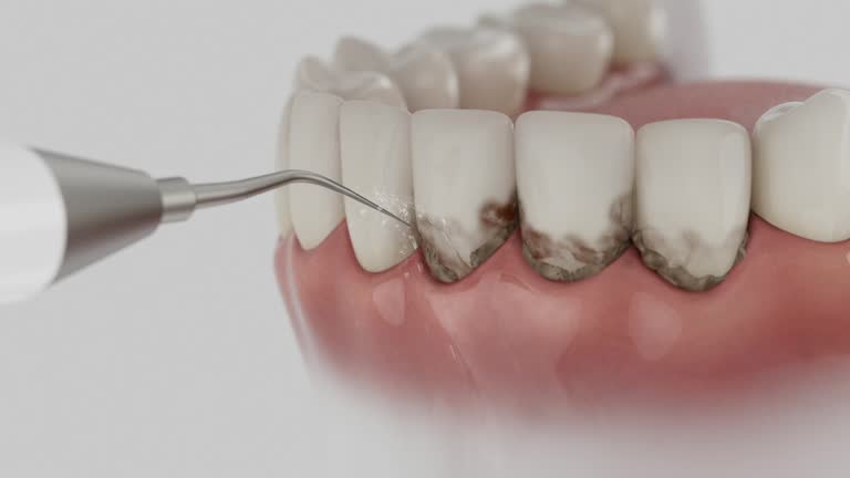 Trusted Dental Crowns And Bridges service in Bremen, IN - Dentist Open Now